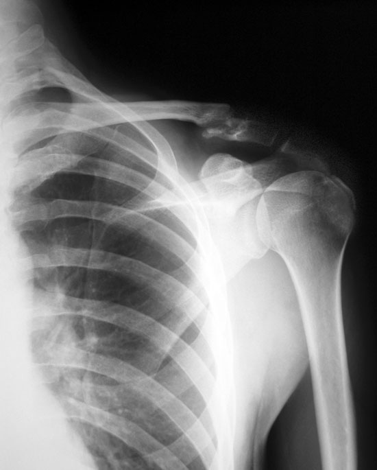 Left_Shoulder_Xray_IMG_5700.jpg